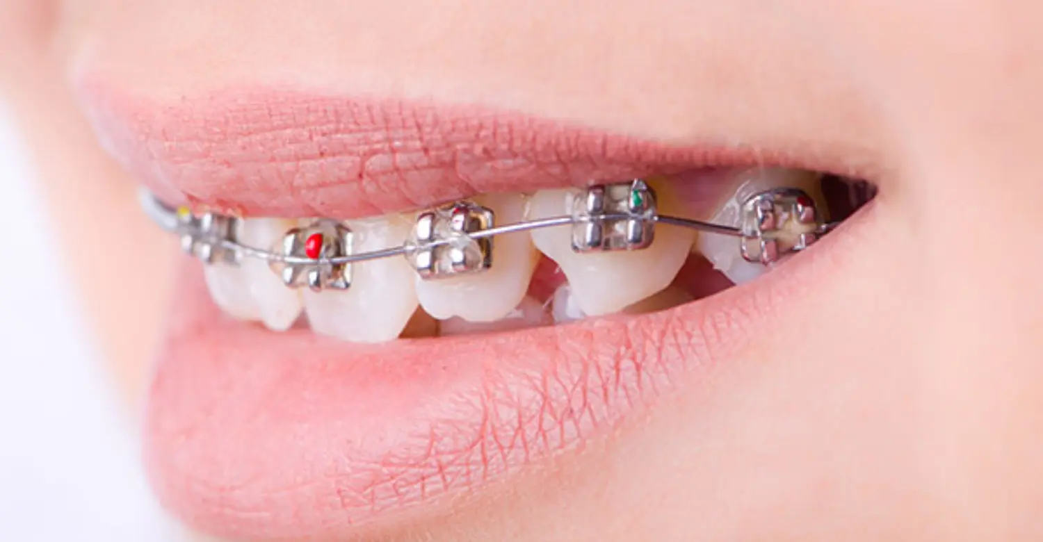 Braces for Crooked Teeth 2